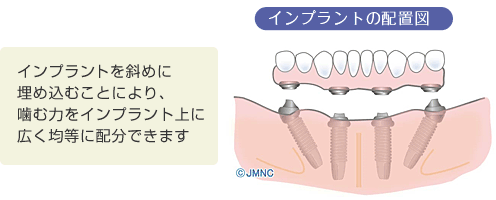 ワンデーインプラント